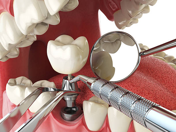 Best Knocked-Out Tooth (Avulsed Tooth) Treatment in Andalusia, IL